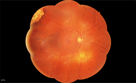 Fundus Mosaik
